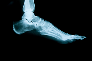 Foot Traumas and Fractures